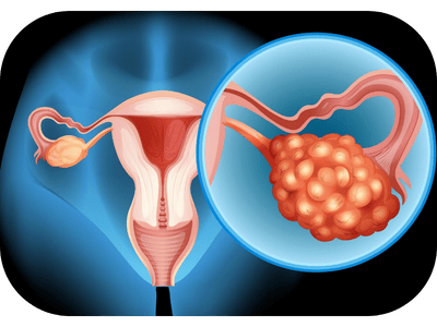 Ovarian Cancer Case Study