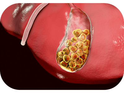 Gallstone Treatment
